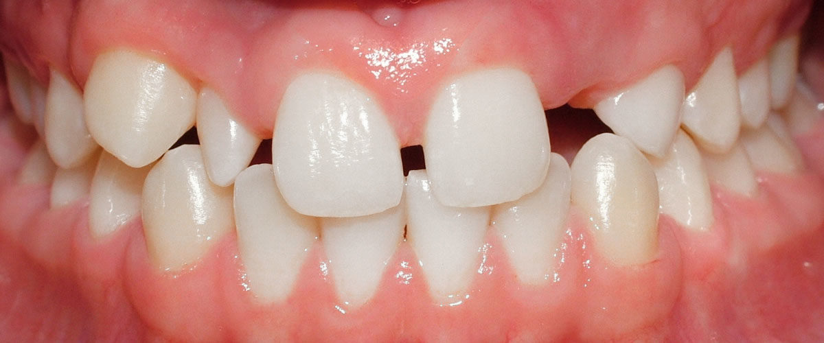 How can I fill a missing tooth at home?