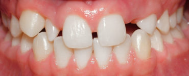 How can I fill a missing tooth at home?