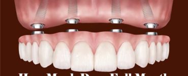 How much does a full set of teeth implants cost?