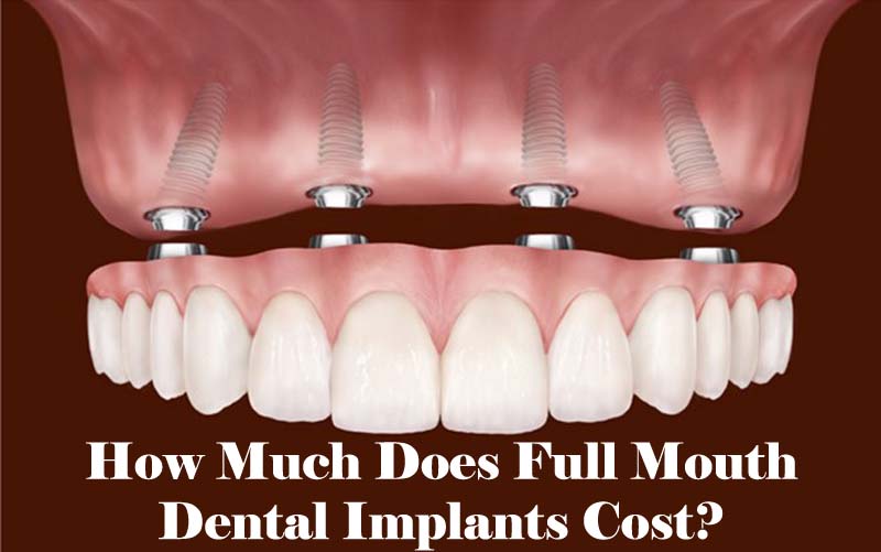 How much does a full set of teeth implants cost?